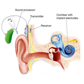 MAA ENT Clinic | Cochlear implants | Cochlear implants | ENT Specialist In Hyderabad | ENT Specialist In Hyderabad | cochlear_implants_surgery_cost | cochlear implant surgery cost | cochlear implant surgery in hyderabad | cochlear implant surgery cost in india | cochlear implant cost in hyderabad | cochlear implant surgery cost in hyderabad | best doctor for cochlear implant in india | best hospital for cochlear implant in india | best cochlear implant in india | best place for cochlear implant surgery | cochlear implant in hyderabad | best cochlear implant surgeon in hyderabad | best hospital for cochlear implant surgery
