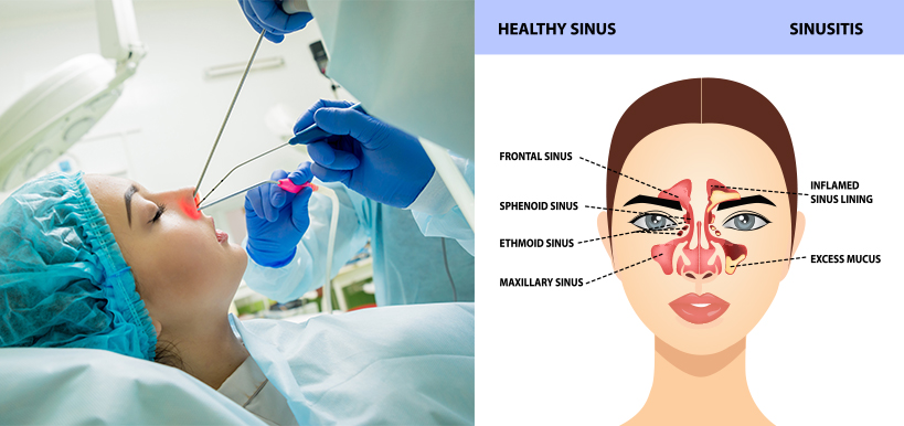 MAA ENT is one of the very few best hospitals for advanced sinus surgery in Hyderabad